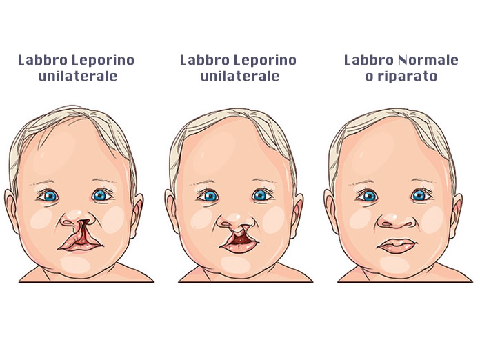 Labbro Leporino (o Labioschisi) nel bambino: cause, conseguenze. Si vede dall'ecografia?