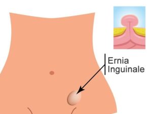 Ernia Inguinale: sintomi, rimedi, quando preoccuparsi, intervento